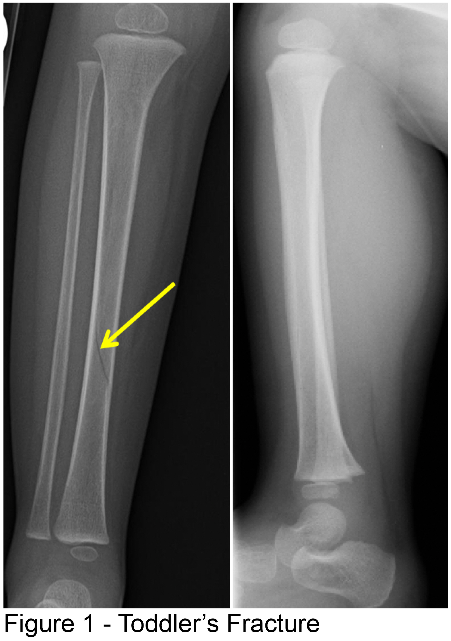 An Approach to Management of Toddler's Fractures