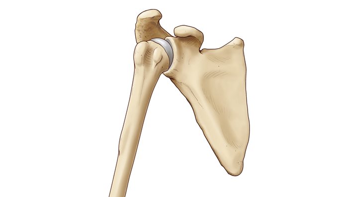 Illustration of shoulder joint with labrum tear