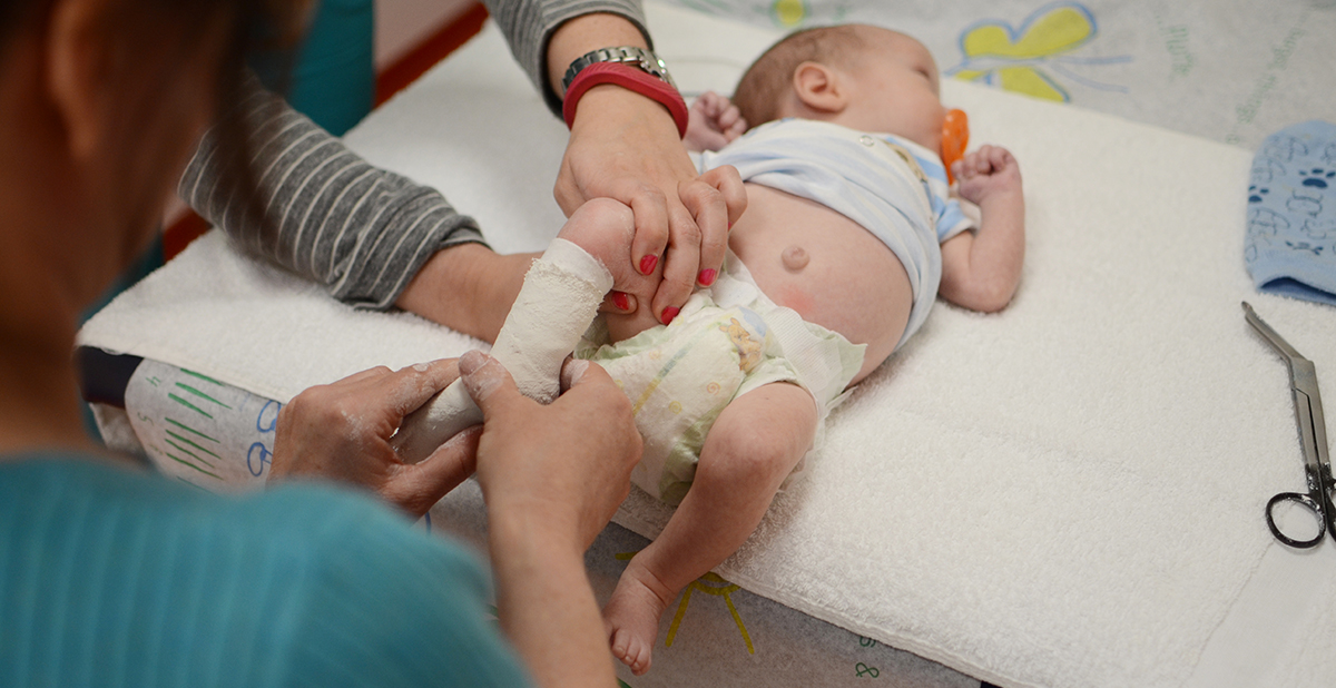a baby being casted for clubfoot