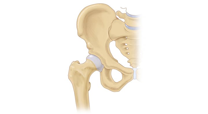 Illustration of hip joint with athletic injury labral tear