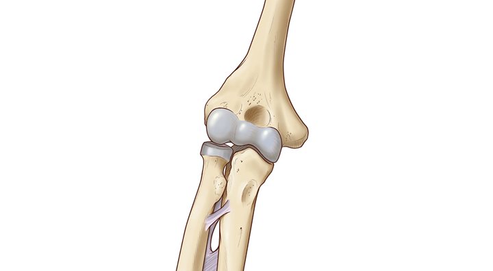 Illustration of elbow joint with athletic injury, “Little Leaguer’s Elbow” or medial epicondyle apophysitis