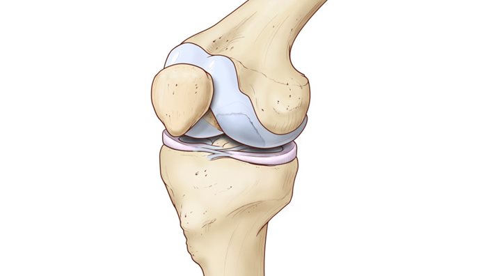 Illustration of joint with osteochondritis dissecans (OCD)