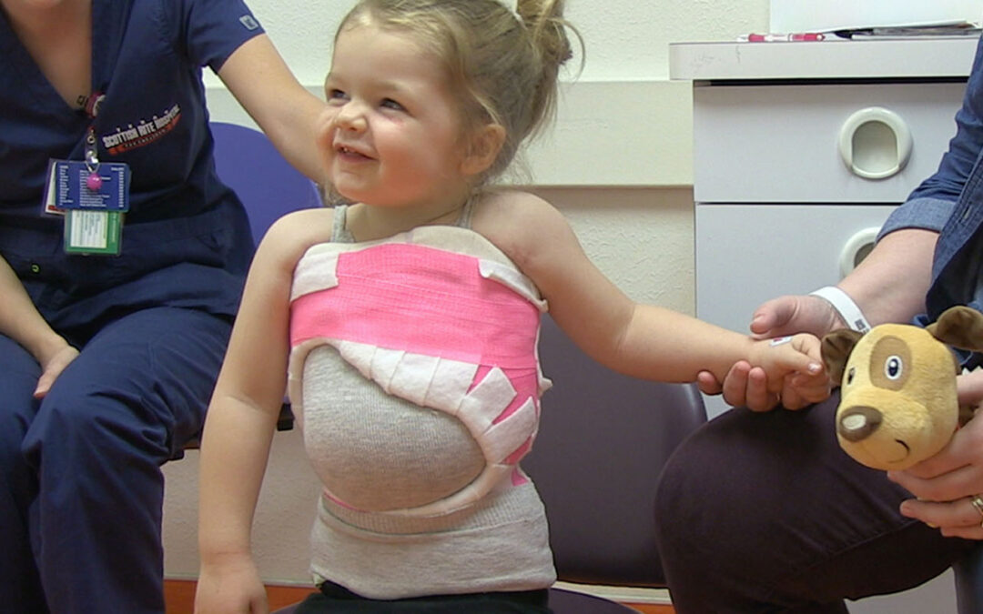 Scoliosis Awareness Month: Casting for Scoliosis