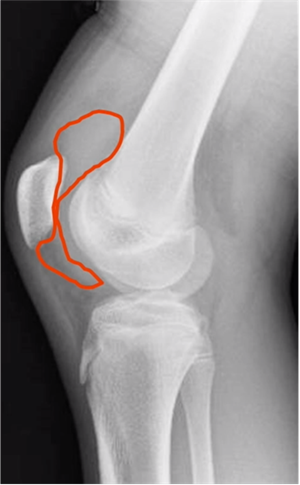 X-ray of a knee