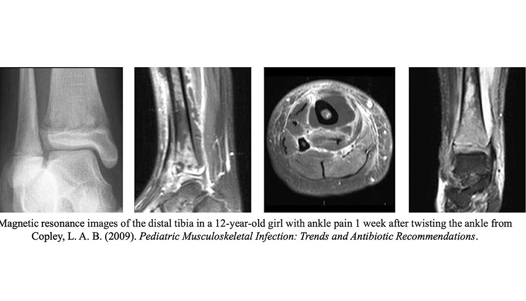 Healio Orthopedics Today: Accelerated severity of illness score may enhance predictions for pediatric osteomyelitis