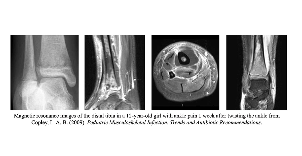 Healio Orthopedics Today: Accelerated severity of illness score may enhance predictions for pediatric osteomyelitis