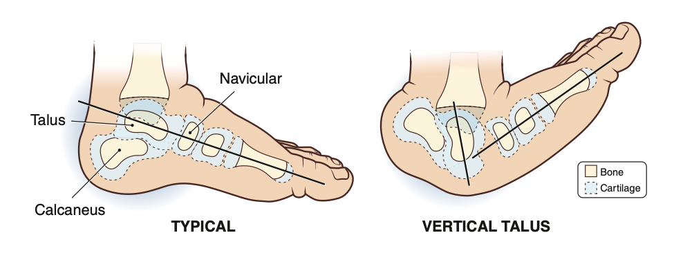Vertical Talus Diagram